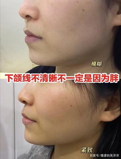 下颌线不清晰不一定因为胖!