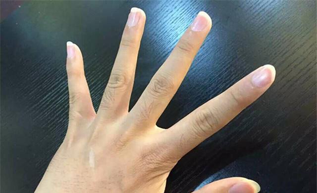 手指关节疼痛僵硬是怎么回事是类风湿吗不妨了解一下