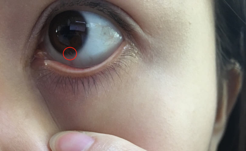 眼睛角膜起泡,有异物感