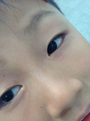 问:眼睛下面长白色的米粒,不痛不痒是什么东西.10岁,男孩