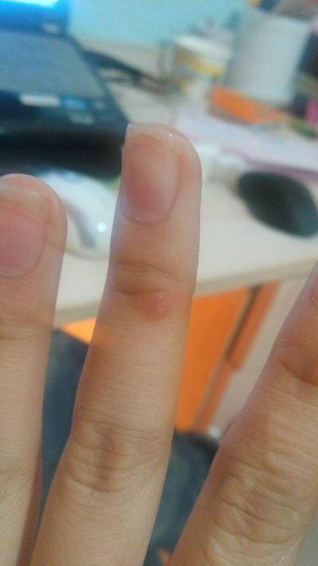 手指上长了一个硬疙瘩,接近一个多月了,有几次我用剪刀把它剪平了