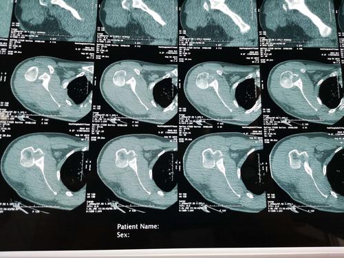 水平位ct显示肱骨头后脱位.