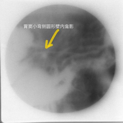 胃窦小弯侧龛影