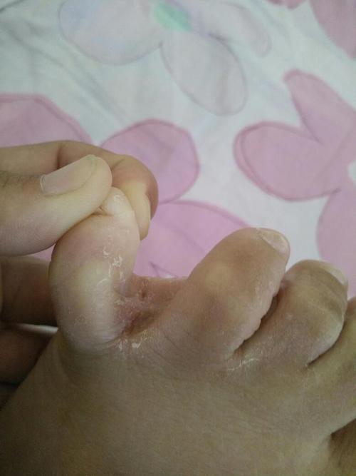 看看我的烂脚丫,都痒死了,大家都有什么好办法没?受不了