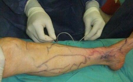 常见的静脉曲张症状及诊断方法