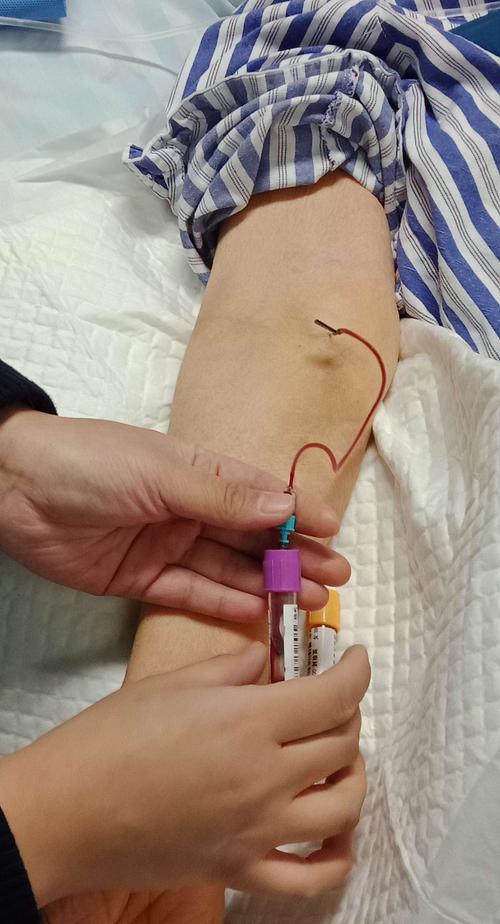 采血针直接穿刺肱动脉,原来动脉血气和静脉采血可以一次解决.