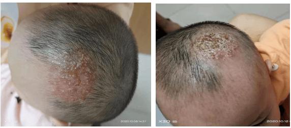 检查结果证实了李医生的判断,经过合理,规范的治疗,小婕头皮红疹子