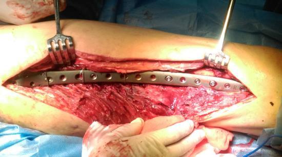 八旬老者两次粉碎性骨折黑龙江省医院成功为其手术