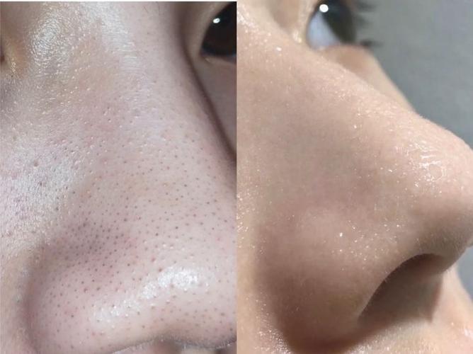 一步到位和黑头说拜拜~ 火速给大家看看我前后对比图!