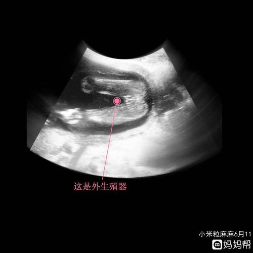 这是14周男宝宝和女宝宝***图片!宝!
