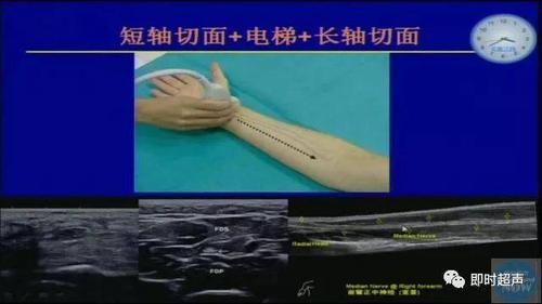 专家课堂01崔立刚上肢神经的超声识别技巧常见病变