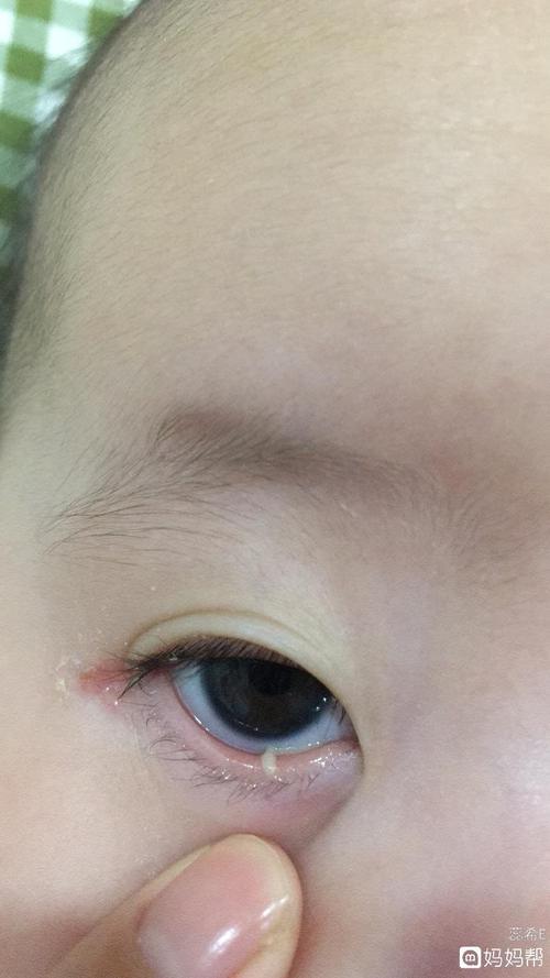 宝宝泪腺堵塞 求助