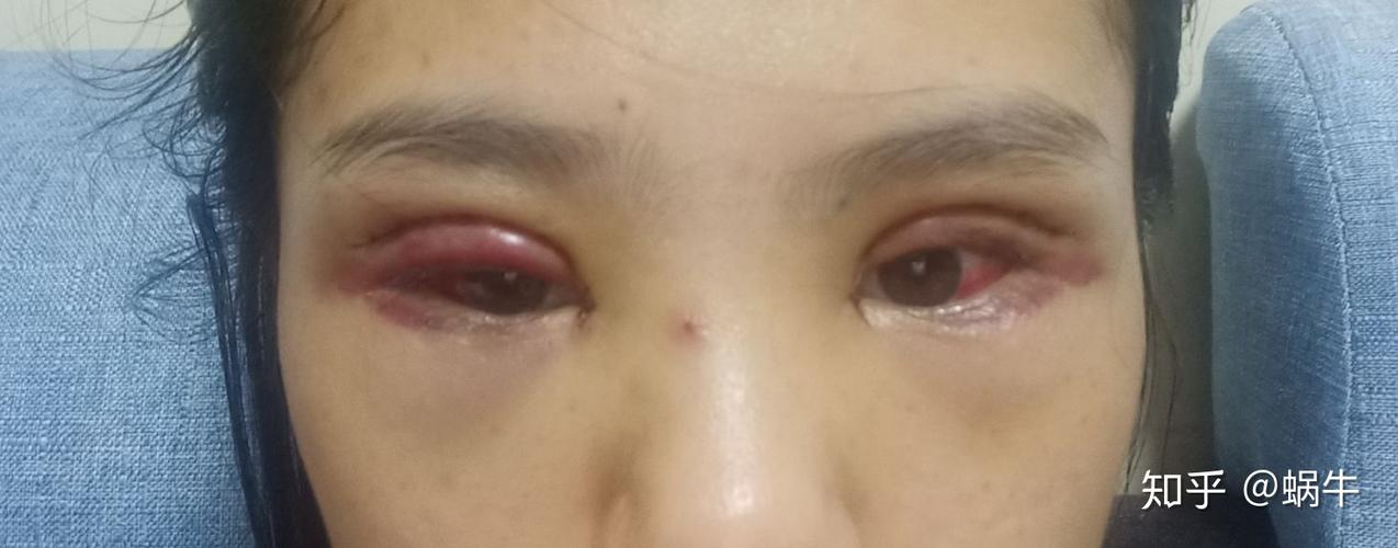 第二天 大小眼严重,医生让我多睁眼,说这是正常的,眼球眼白充血,下