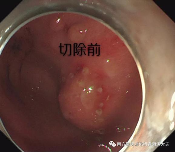 cm隆起,术前诊断考虑胃底间质瘤(壁内型),行内镜下切除,未见穿孔,术后