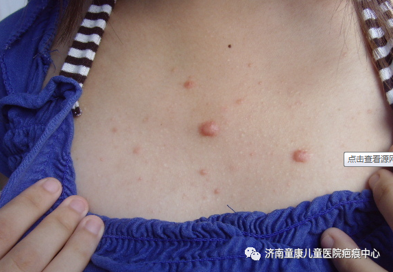 在门诊经常会碰到一些胸前长疤形成疤痕疙瘩的患者,她/他们跟医生