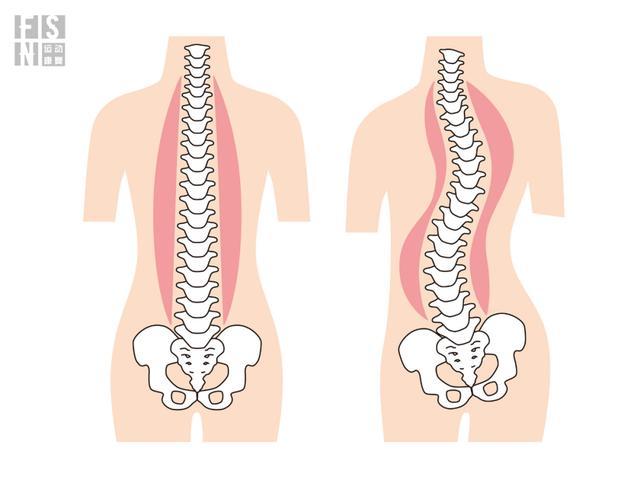 普通运动能改善脊柱侧弯吗?