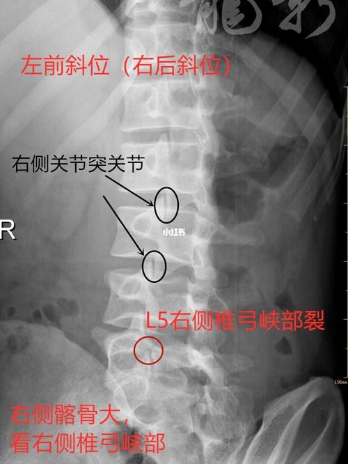 男性,(椎弓峡部裂s1椎板隐裂)25岁,腰痛半年._腰痛
