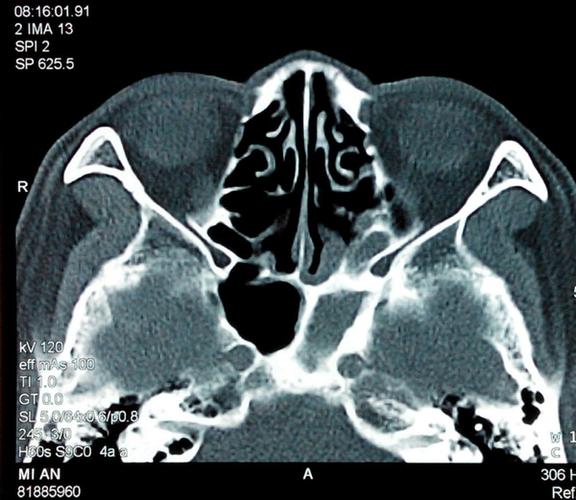 有一种头痛叫做蝶窦炎症