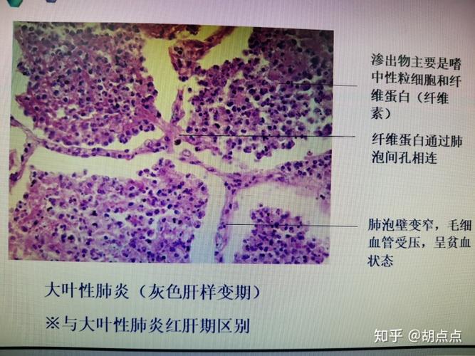 大叶性肺炎小叶性肺炎病理组织切片