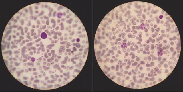 临床检验案例:儿童血小板异常升高