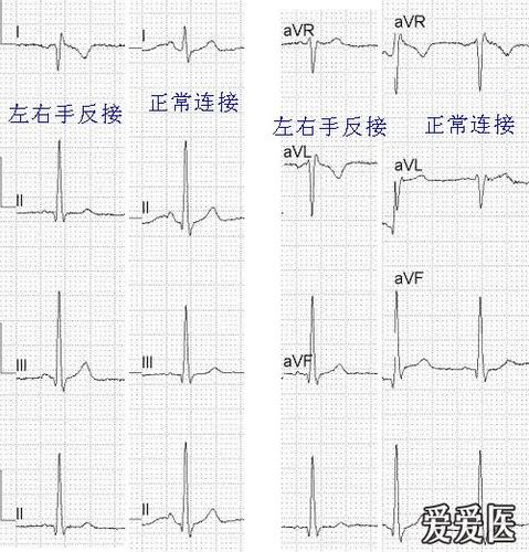 看图学心电01左右手反接与镜像右位心