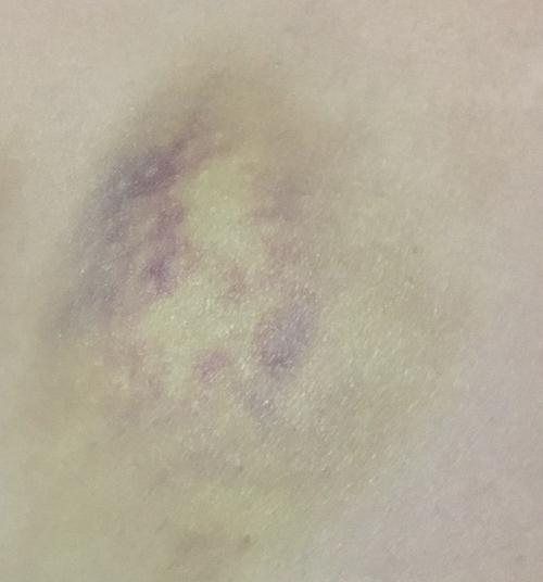 小绿人集美们的淤青是什么颜色