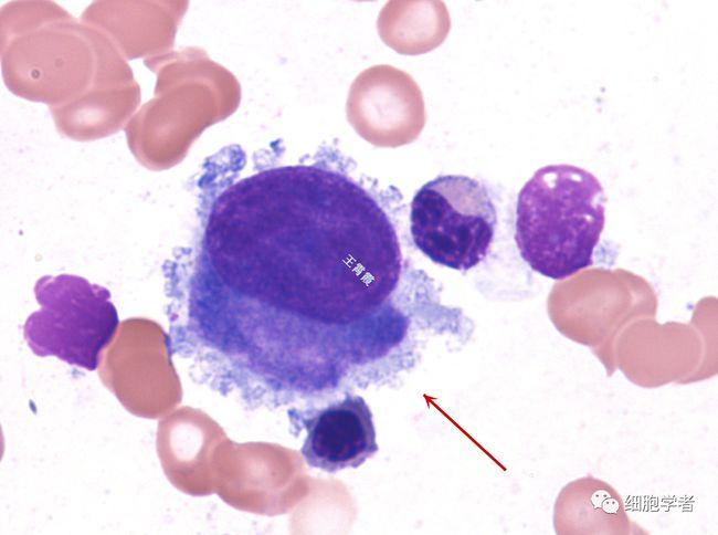 幼稚巨核细胞   26