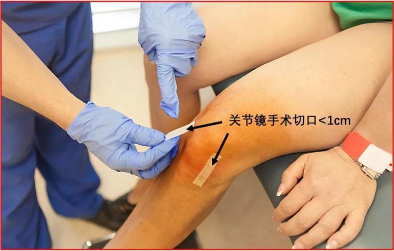 Ⅲ度损伤,代表半月板撕裂性损伤,裂隙达到关节面.