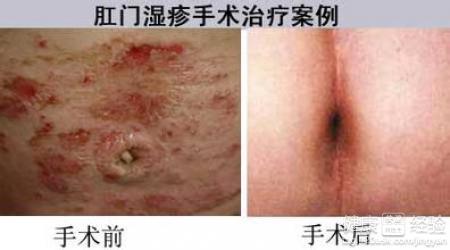 因为她怀孕了,但是她却遇到了一个麻烦,那就是肛门周围出现了湿疹的