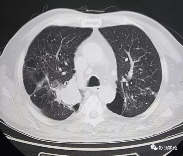 胸闷,咳少量白痰——肺癌,颅内转移瘤