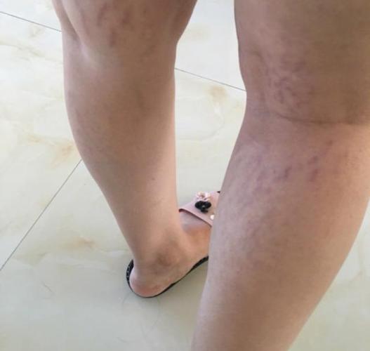 但是最常见于腰上和大腿部位的肥胖纹,却是由于我们忽然增重的体格,让