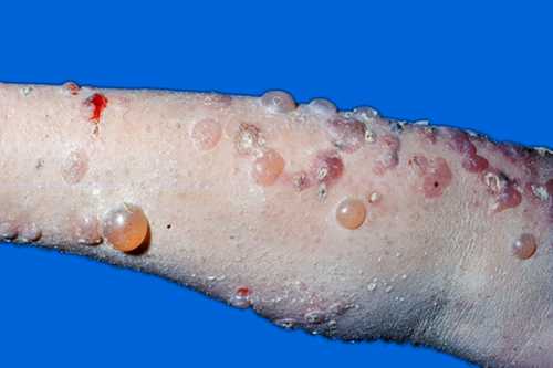 大疱性类天疱疮