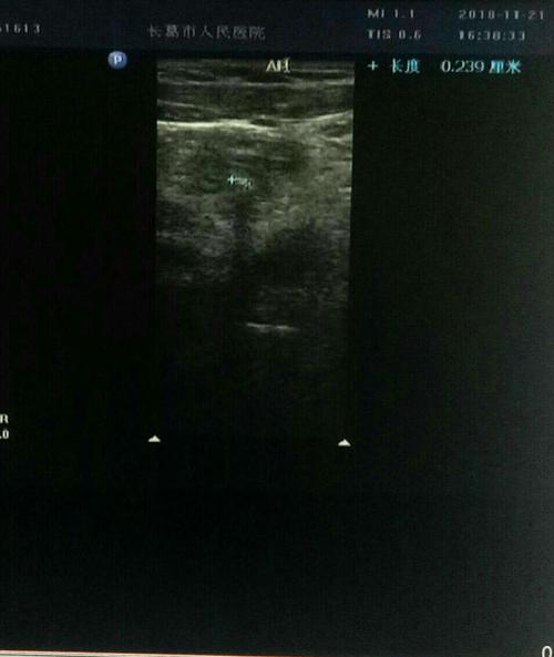 超声显示:阑尾腔内粪石,后方伴弱声影.