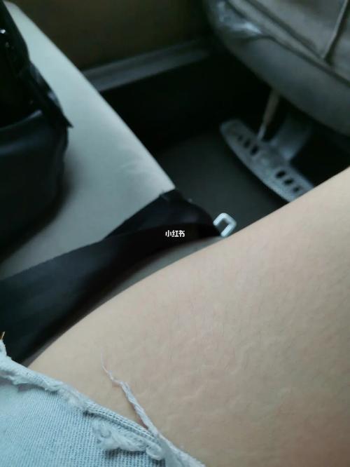 这是胖的生长纹吗_肥胖纹_生活记录_接地气生活