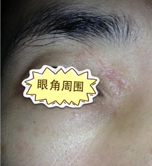 是否是使用,盐酸左氧沙星滴眼液,皮肤过敏