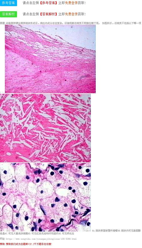 所有题库 病理学高级职称题库 试题二 题目详情  动脉粥样硬化粥样
