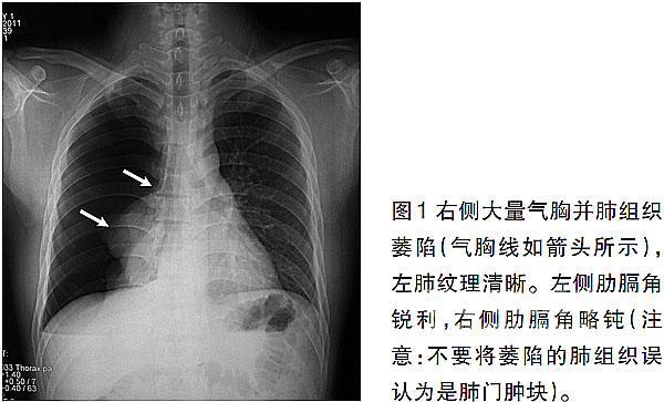 气胸患者胸部x线表现