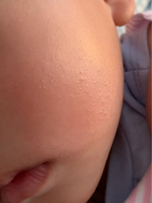 宝宝毛周角化 小疙瘩_脂肪粒_湿疹_保湿乳_母婴_育儿