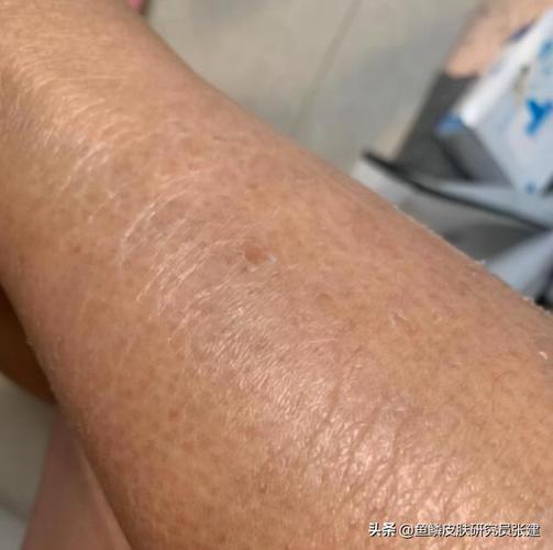 鱼鳞病一到秋冬季就起皮脱屑严重还伴有干痒其根源在这里