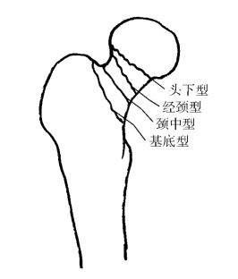 股骨颈骨折的分类骨折分类与功能评