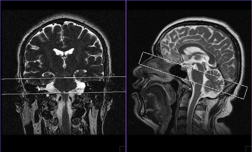 【影像技术】磁共振(mri)三叉神经,面神经,听神经(内听道)扫描技术