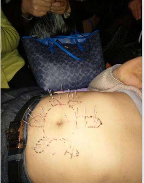 学习针灸-众安康中医培训-学习针灸推拿人