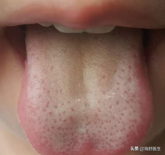 中医图解宝宝舌苔舌苔白腻齿痕舌地图舌教你从舌苔看健康