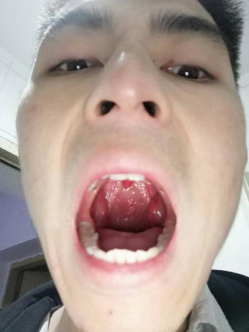 请问喉咙两边肿起来好多年了 碍不碍事 有时候感冒的时候有点疼 一般