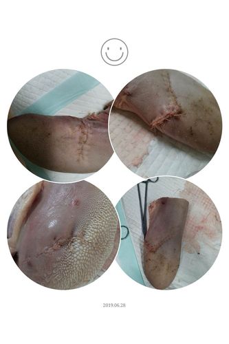 会阴裂伤缝合技术直接关系到产妇产后伤口的愈合质量,通过提高该技术