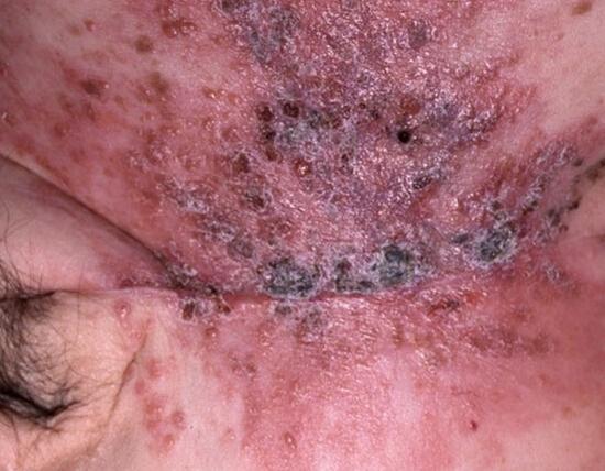 图文并茂:教你分分钟看懂皮肤转移癌