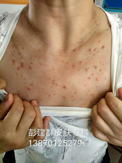 表现为毛囊性红色丘疹,丘疱疹或小脓疱等