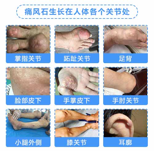 已经出现痛风石,能不能治好?