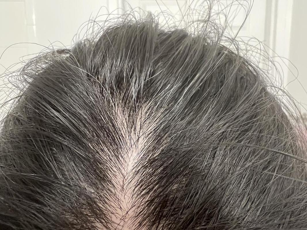 头顶突然长出一撮白头发