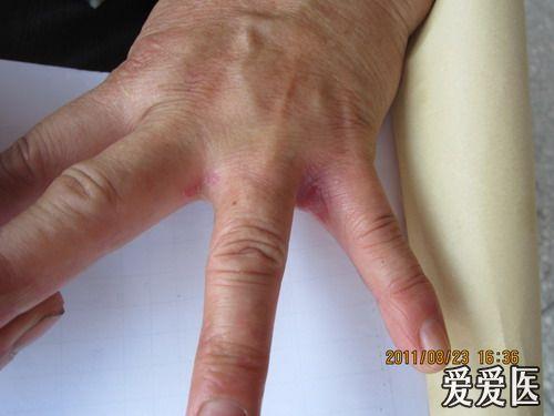 看图诊断——念珠菌性间擦疹 - 皮肤及性传播疾病讨论